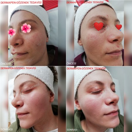 TRABZON'DA DERMAPEN TEDAVİSİ...