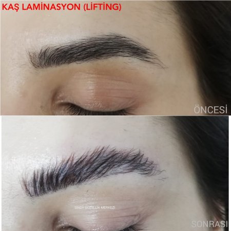 TRABZONDA KİRPİK LİNFTİNK...