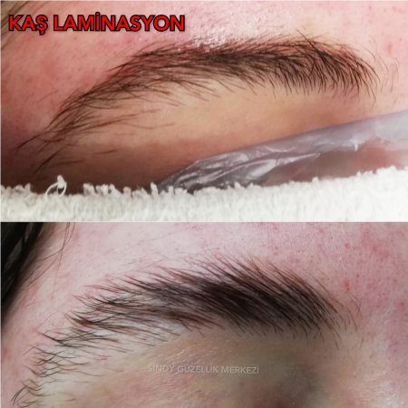 TRABZON'DA KAŞ LAMİNASYON